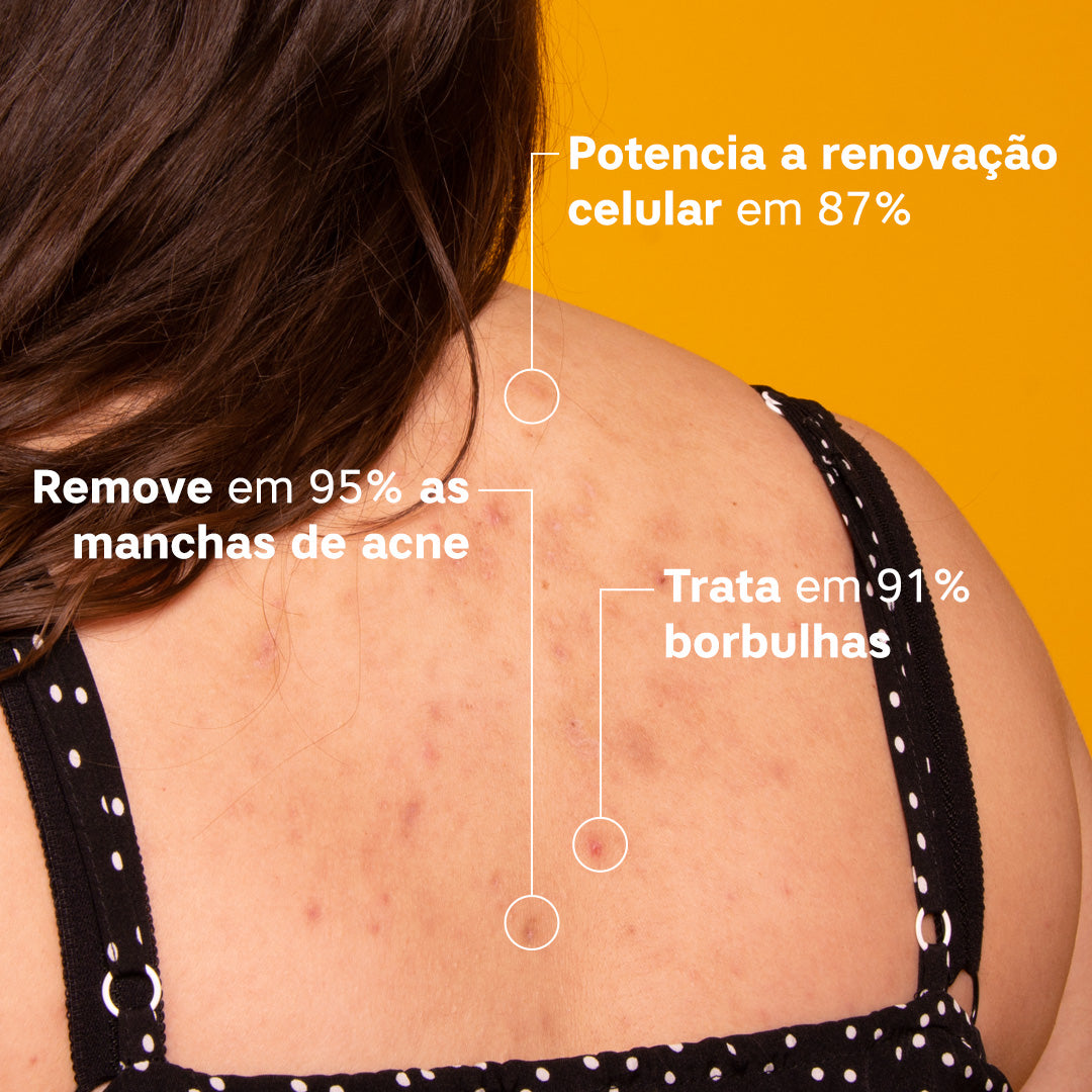 ByePimples Body